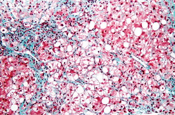 Image: Micrograph of a liver biopsy showing steatohepatitis (Photo courtesy of Nephron).